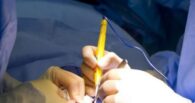 romanian woman set on fire during surgery