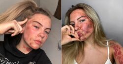 Woman with undiagnosed skin condition embraces her natural look by going makeup-free