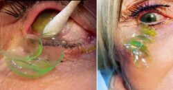 Woman learns hard way why you shouldn’t sleep with contact lenses in