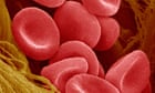 New hope for sickle cell patients as UK trial of lab grown red blood cells begins
