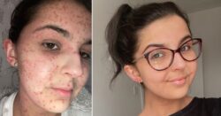 Woman looking forward to pain-free Christmas after battling agonising skin condition