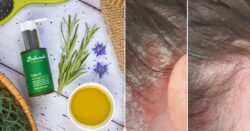 Shoppers hail this rosemary oil a ‘miracle’ for psoriasis and thinning hair: ‘Wish I had found this years ago’