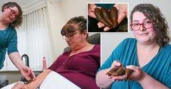 Woman owns 35 pet leeches and uses them to treat her mum’s arthritis