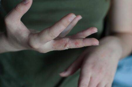 Doctors warn of ‘nightmare’ scabies outbreak across UK